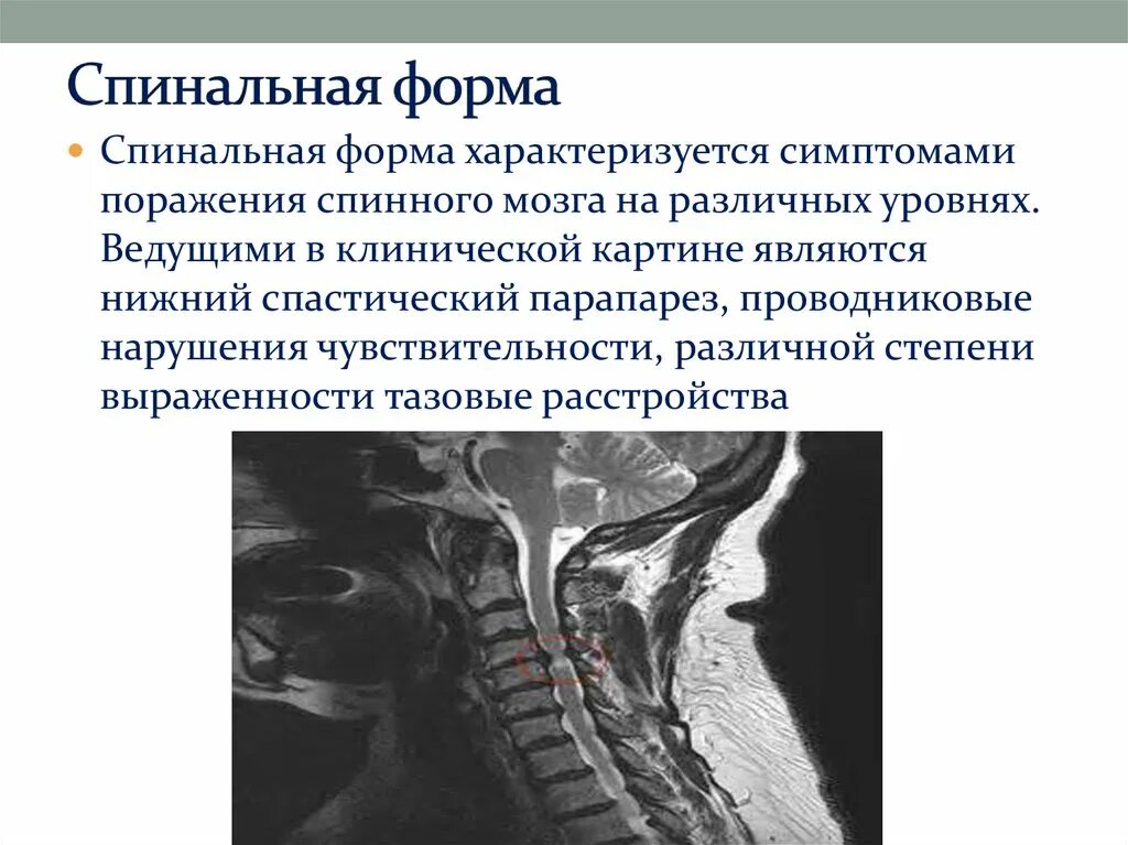 Спинальная нестабильность что это. Мрт спинного мозга рассеянный склероз симптомы. Рассеянный склероз спинальная форма. Рассеянный склероз спинальная форма симптомы.