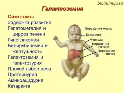 Нарушения обмена галактозы галактоземия по утвержденным клиническим
