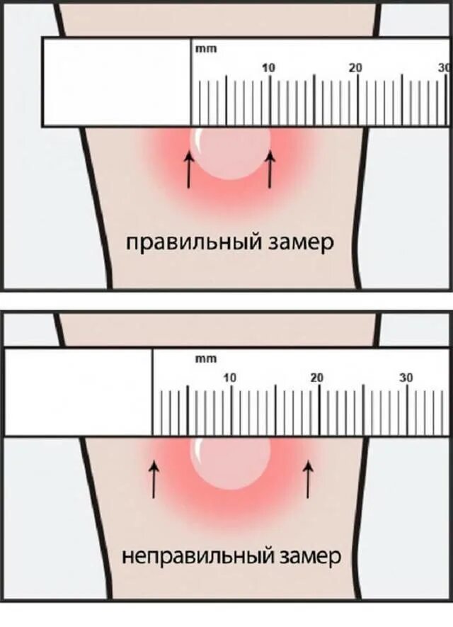 Через какое время манту. Проба манту размеры норма у детей. размеры реакции манту у детей норма. реакция манту норма размера папулы в год. реакция манту норма для ребенка 1 годик.