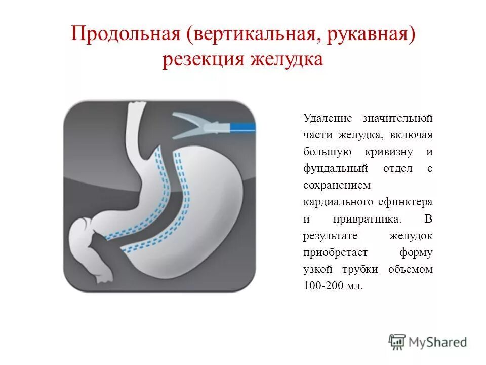 Умер от резекции желудка