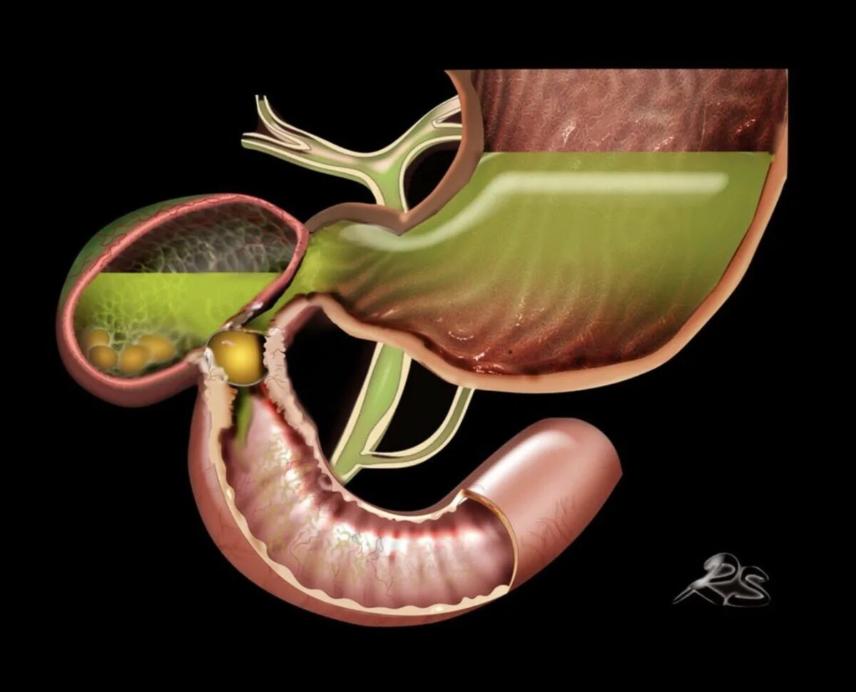 Сердце желчный пузырь. Желчекаменная кишечная непроходимость. Кишечная непроходимость желчным камнем.