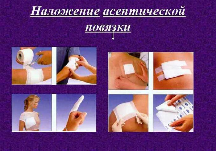 Алгоритм повязки. Наложение асептической повязки. наложение асептической повязки на рану. наложение стерильной повязки алгоритм. наложение асептической повязки алгоритм.