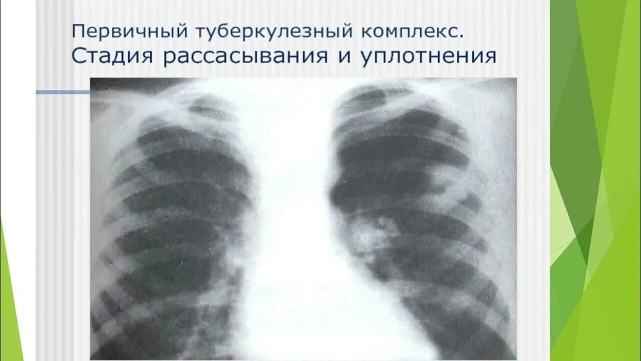 Первичный туберкулезный комплекс фаза уплотнения. Инфильтративный туберкулез рентген. Инфильтративный туберкулез легких в фазе уплотнения. Первичный туберкулезный комплекс в фазе рассасывания.