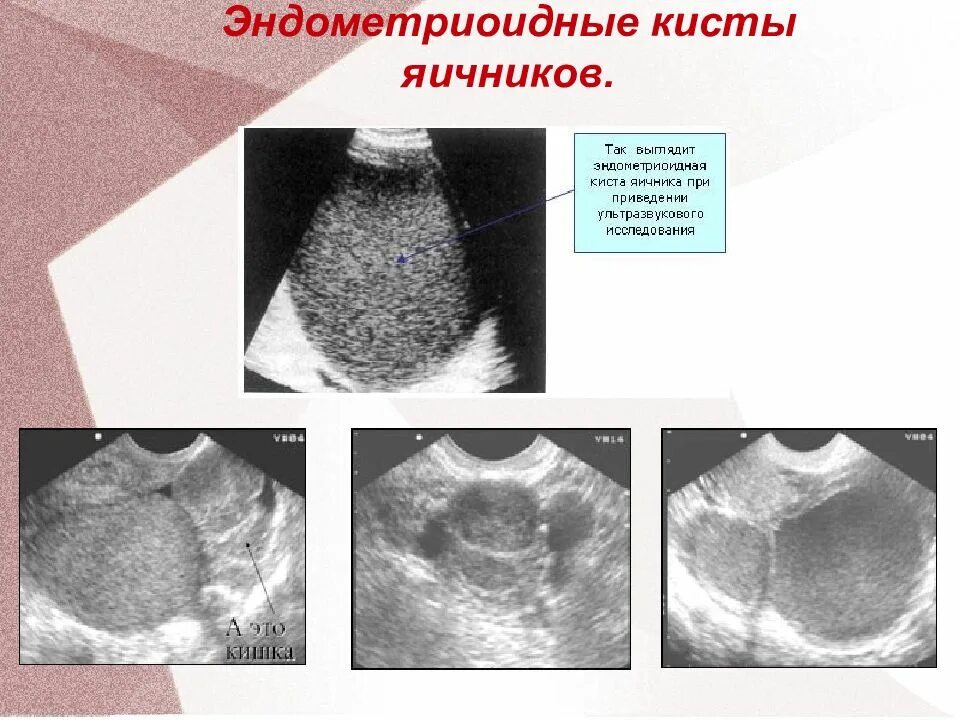 Эндометриоидная киста на УЗИ. Эндометриоидная киста яичника. Эндометриоидная киста яичников. Эндометроидные кистомы яичника. Киста размеры для операции