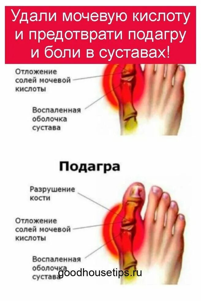 Как выводить мочевую
