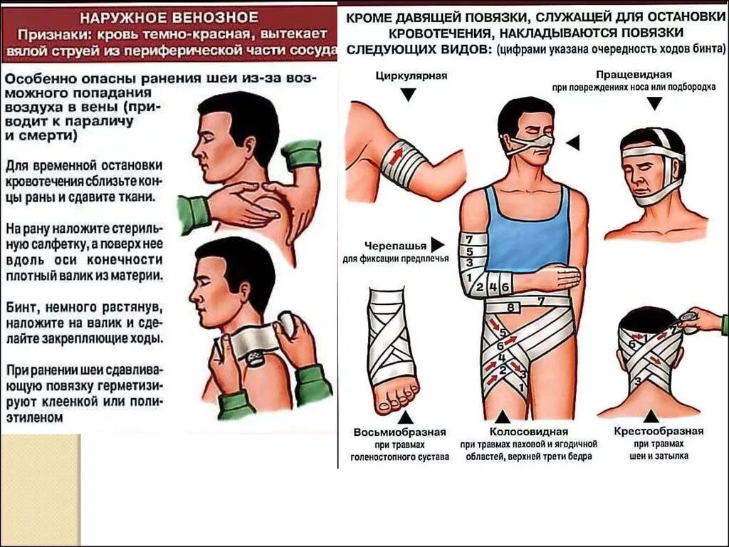 Способы наложения повязок при кровотечении. Наложение повязок при ранениях и кровотечениях. Наложение повязки при ранении. Наложение повязки при кровотечении. Наложение повязок при различных кровотечениях.