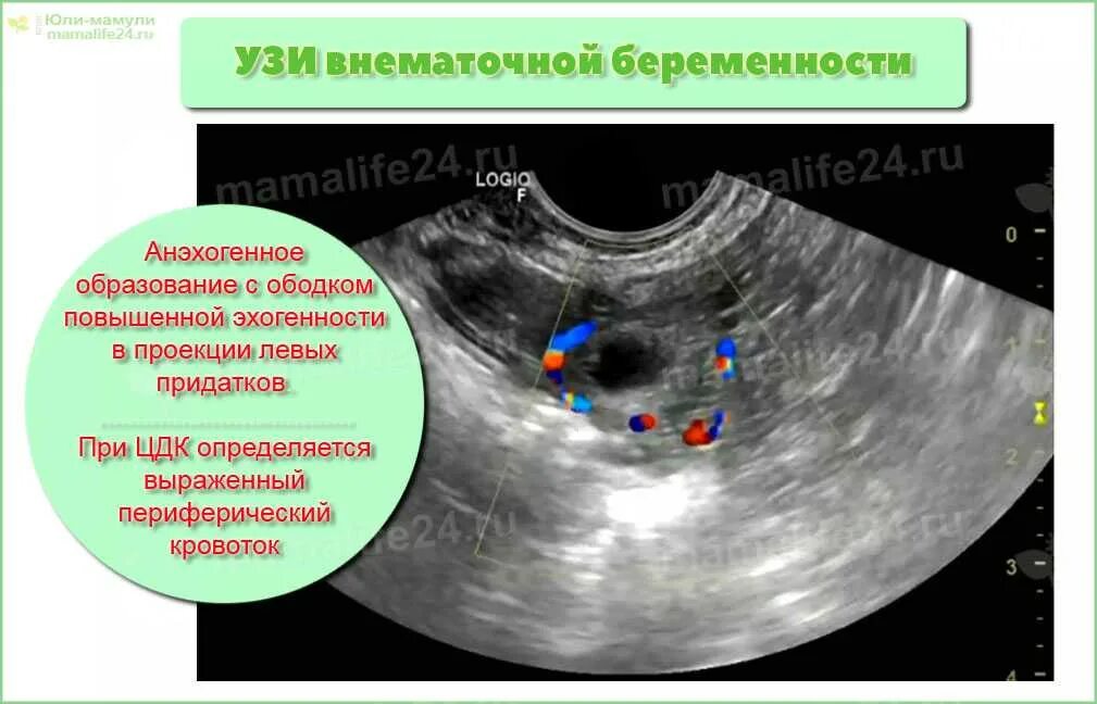 Внематочная беременность симптомы тест покажет или нет. Внематочная беременность на узи. внематочная беременность тест. внематочная беременность узи признаки. на узи внематочная беременность - показать.