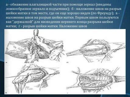 Ушивание шейки матки