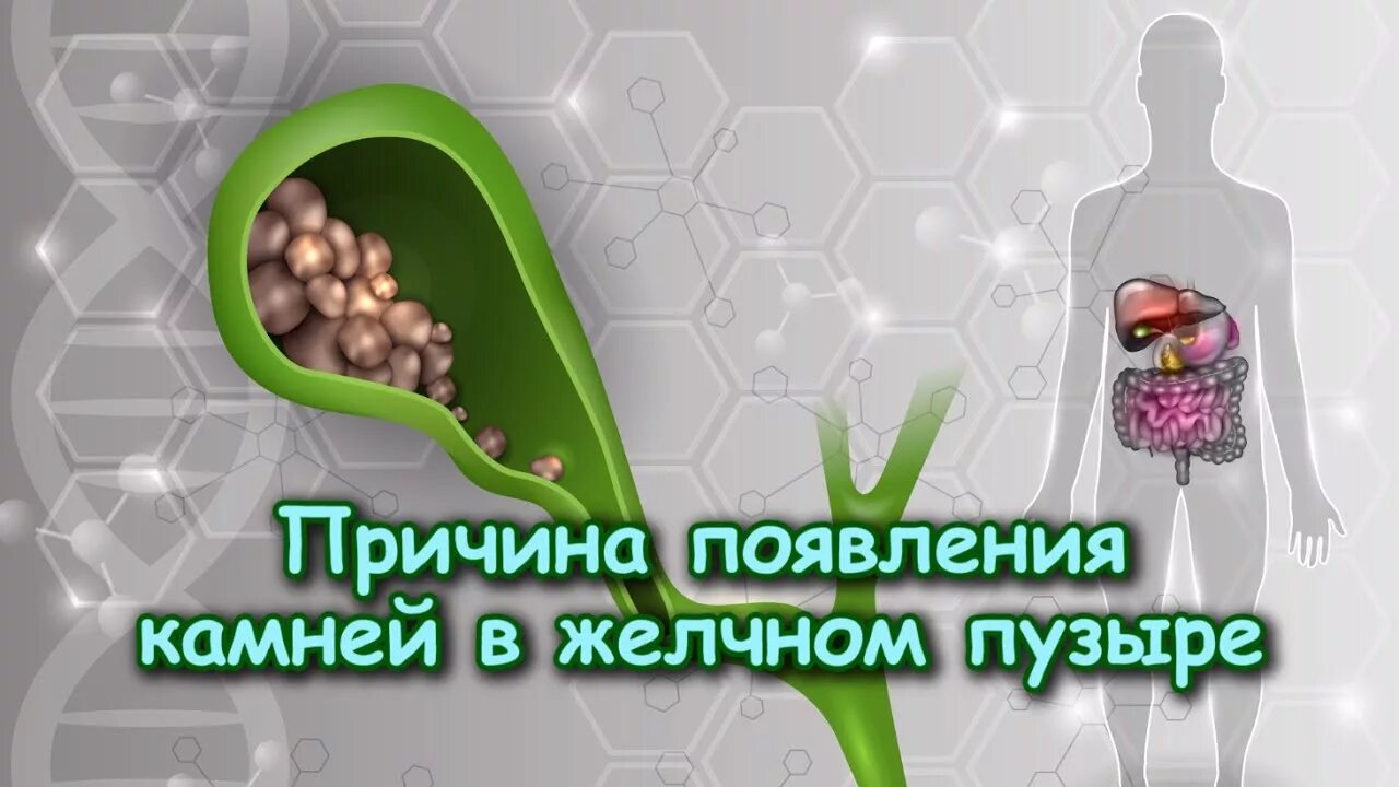 Растворить камни в желчном пузыре народными. Камни из желчного пузыря. Причины возникновения желчных камней.