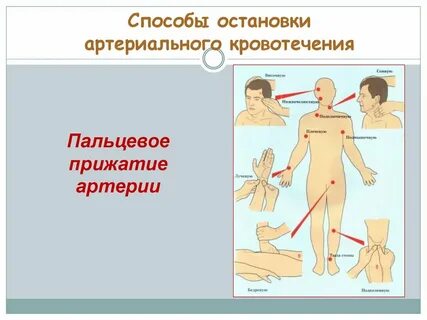 Для остановки кровотечения применяют пальцевое прижатие