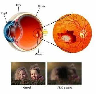 Age related macular degeneration