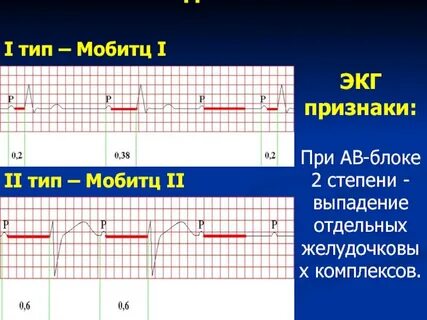 Блокада мобитц 1
