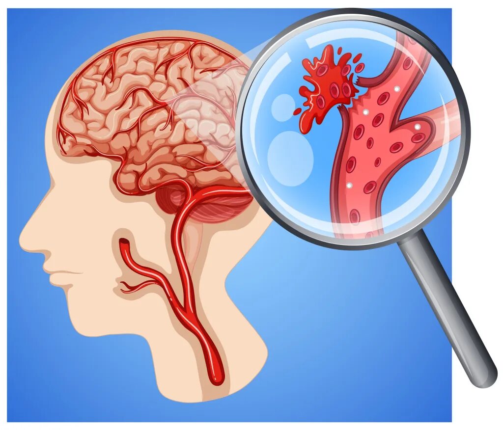Имеет крови мозга и. Геморрагический инсульт картинки.