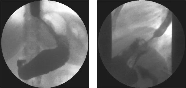 Кардия не смыкается что это значит. Рефлюкс эзофагит рентгенография. Рефлюкс пищевода рентген. Недостаточность кардии на рентгене желудка. Недостаточность кардии пищевода рентген.