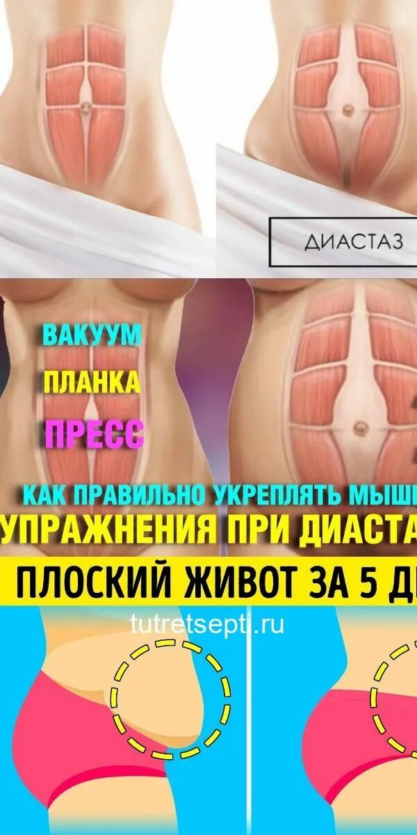 Как избавиться от диастаза мышц живота. Тейпирование диастаза прямых мышц живота.