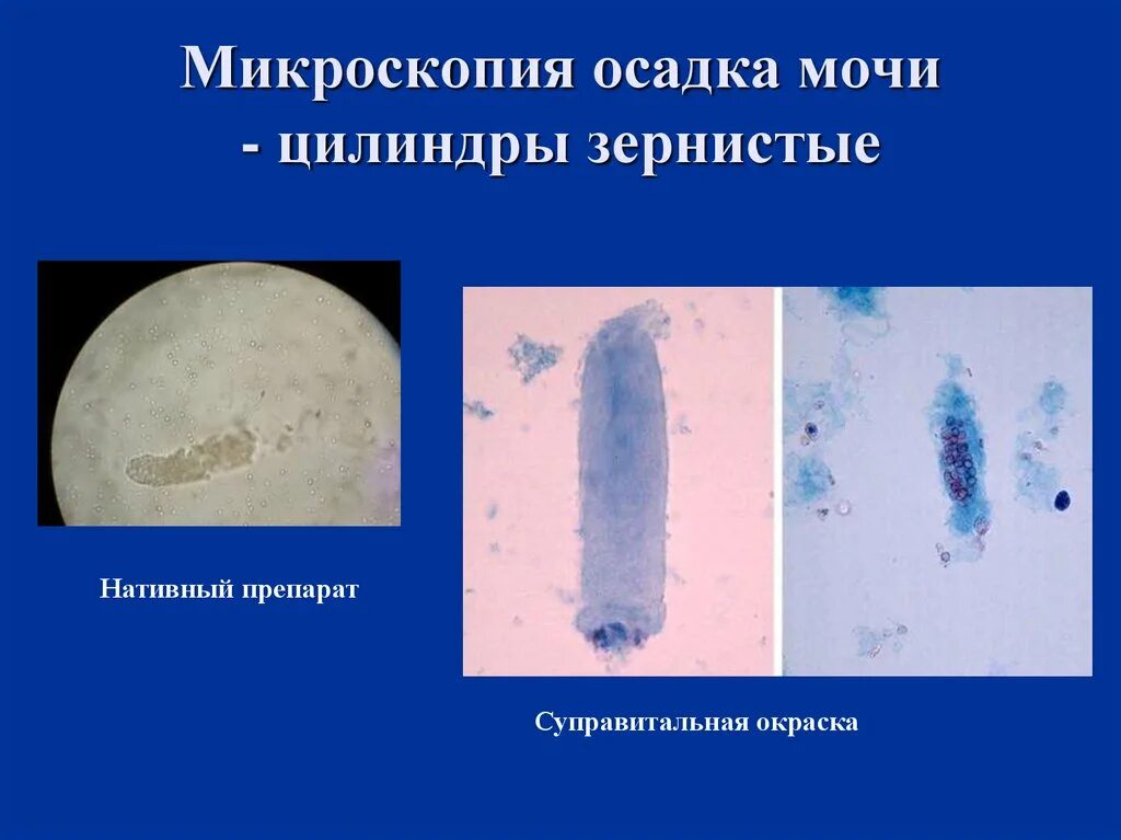 Микроскоп я мочи цилиндр. Микроскопия осадка мочи. Микроскопия осадка мочи цилиндры. Микроскопия мочицелиндры.