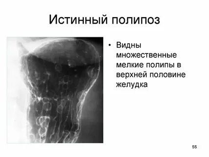Полип матки мкб