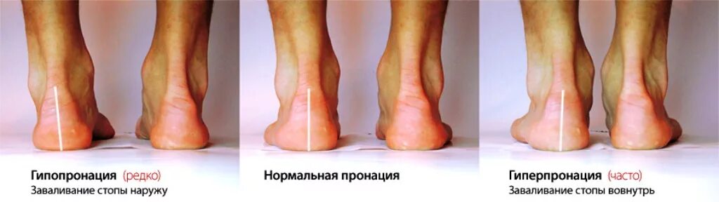 Заваливается стопа при ходьбе