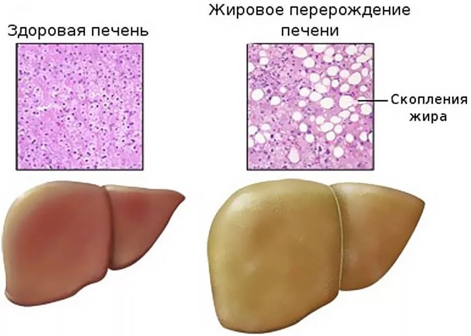 Дегенерация печени к 76.0. Жировой гепатоз (стеатоз) печени. Жировая дистрофия печени макропрепарат. Гепатомегалии стеатоза печени. Жировой гепатоз печени макропрепарат.