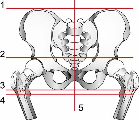 Тест 5 линий. Кости таза линии. Тазовый угол. Гребешковая линия тазовой кости. Линия между гребнями подвздошных костей.