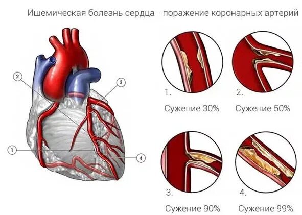 Ишемия передней стенки. Ишемичкскаяболезнь сердца. Ишемическая болезнь сердца причины. Ишемическая болезнь сердца (ИБС).