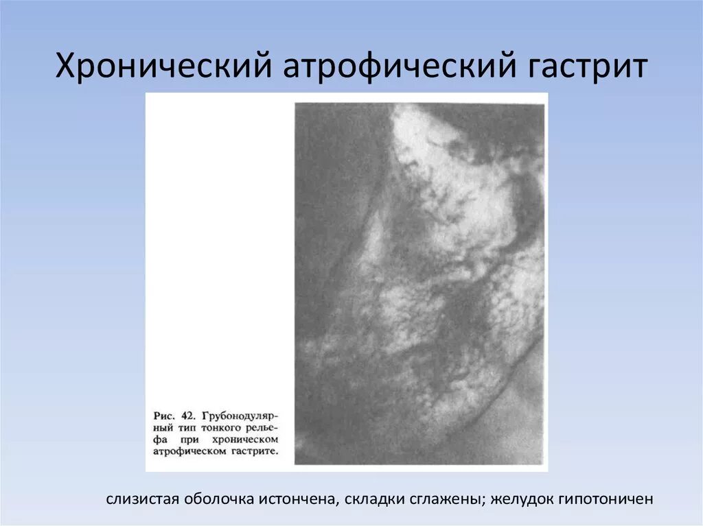 Признаки атрофией слизистой оболочки. Хронический атрофический гастрит рентген. Рентген признаки атрофического гастрита. Атрофический гастрит рентген желудка. Хронический гастрит желудка рентген.