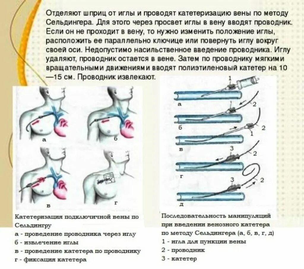 Уход за подключичным катетером. Методу Сельдингера катетеризация. Методика катетеризации по Сельдингеру. Катетеризация сосудов по Сельдингеру. Техника катетеризации подключичной вены.