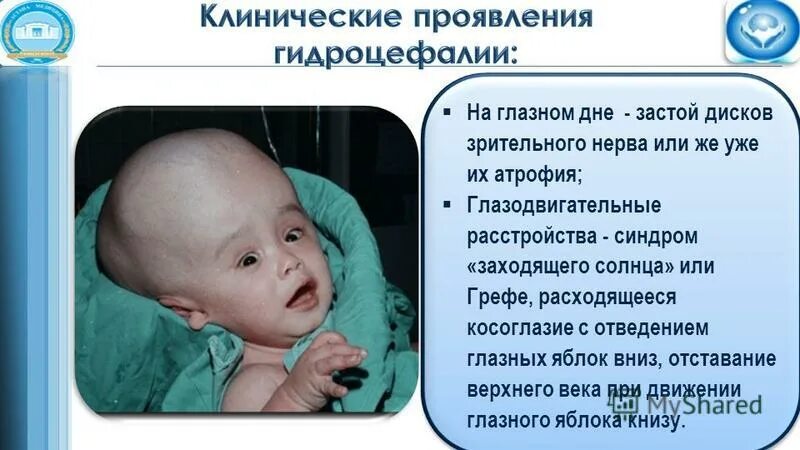 Синдром грефе у новорожденных симптомы. Симптом заходящего солнца. Симптом заходящего солнца симптом грефе. Симптом заходящего солнца. Симптом заходящего солнца.