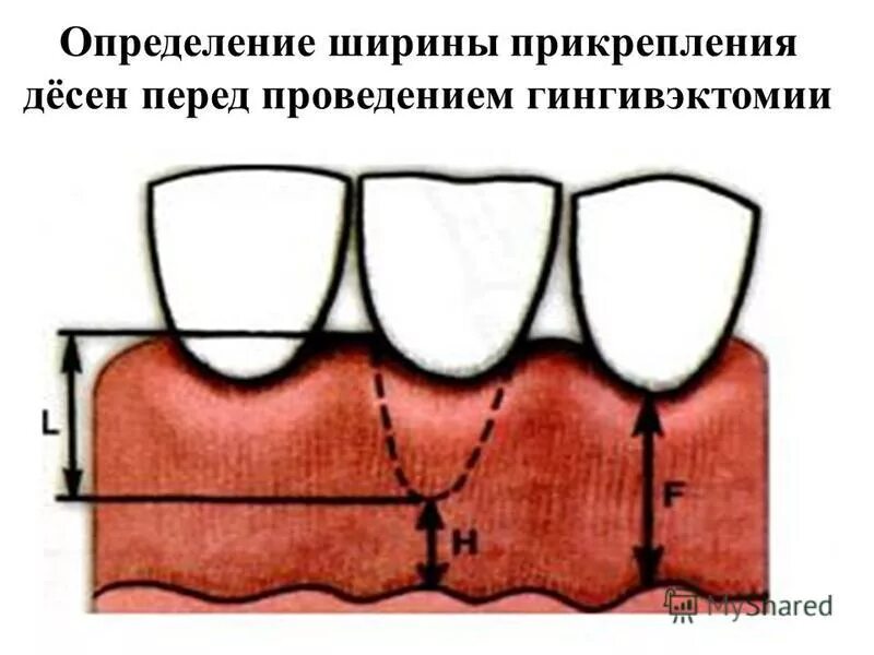 Прикрепленная десна