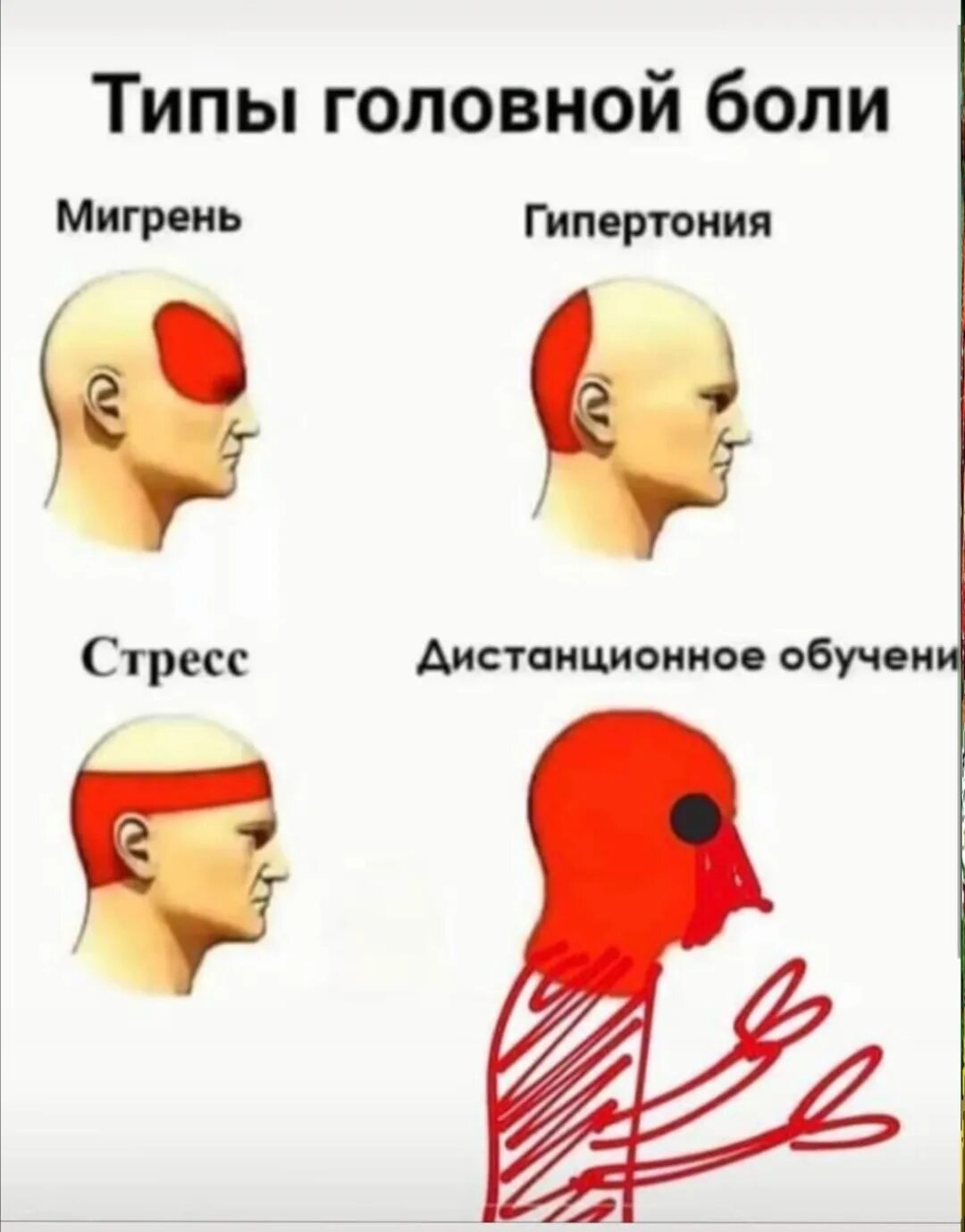 Типы головной боли. Виды головной боли и причины. Боль в голове. Типы боли в голове