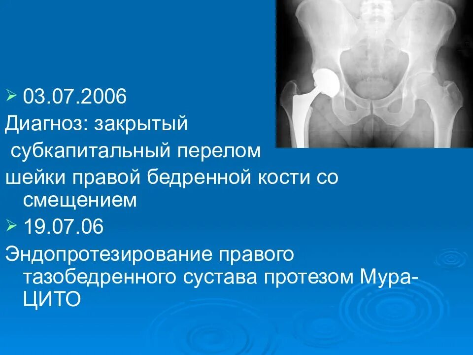 Перелом шейки бедра мкб 10 у взрослых. Закрытый субкапитальный перелом шейки правой бедренной кости.. перелом шейки бедра формулировка диагноза. перелом шейки бедра диагноз. формулировка диагноза перелом.