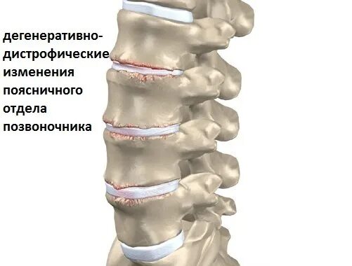 Начальное дегенеративные изменения шейного отдела. Дегенеративно-дистрофические изменения l2 l3. Дегенеративно дистрофические изменения l3-l5. Деформирующий спондилез l1-l3. Межпозвонковый остеохондроз поясничного отдела.