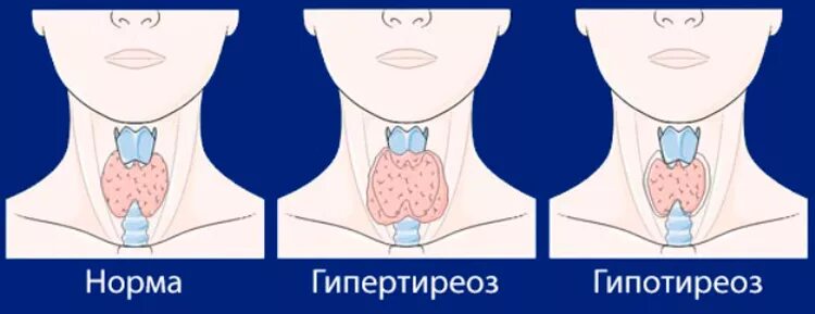 Гипертиреоз лечение у мужчин. Патология щитовидной железы. Гипотиреоз. Тиреоидный гипотиреоз. Заболевание щитовидной железы гипертиреоз. Гипотиреоз и гипертиреоз щитовидной железы.