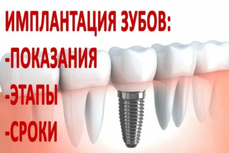 Имплантация время. Продолжительность имплантации. имплантация зуба казахстан.
