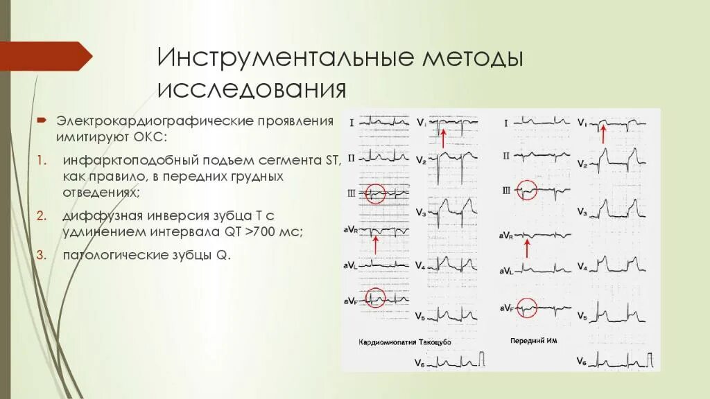 Инверсия зубца т. Инверсия т в грудных отведениях. инверсия зубца t в грудных отведениях. инструментальные методы исследования окс.