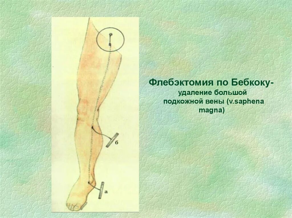 Кроссэктомия операция троянова тренделенбурга. Удаление большой подкожной. Инструмент для удаления ствола подкожной вены. Операция бэбкока длинный стриппинг. Флебэктомия по бэбкокку.