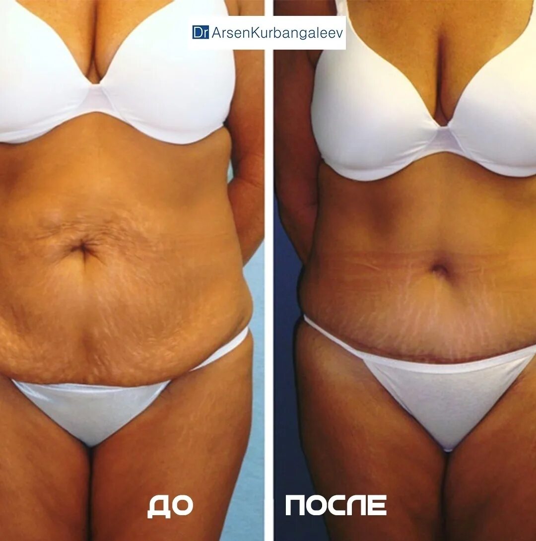 Как подтянуть кожу тела