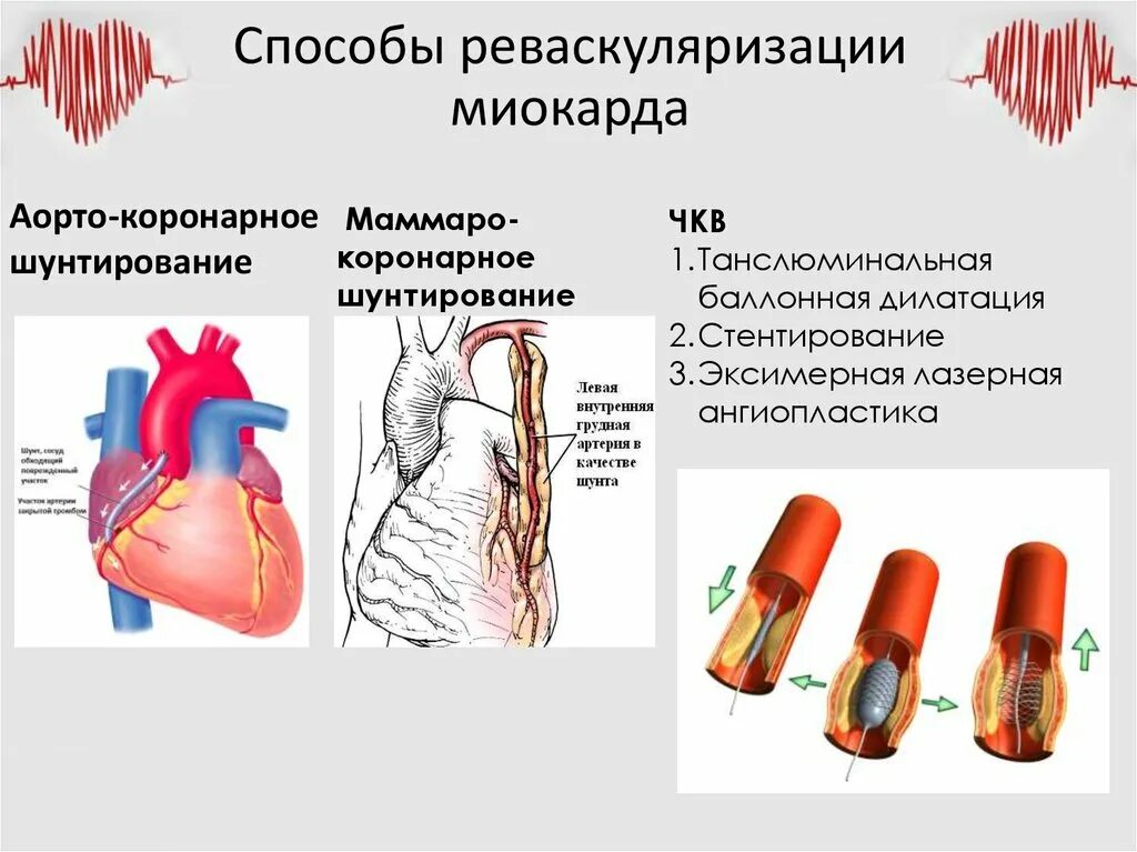 Шунтирование сердца и стентирование. Коронарная реваскуляризация шунтирование. методы реваскуляризации миокарда при ибс. шунтирование коронарных артерий показания. методы реваскуляризации инфаркта миокарда.