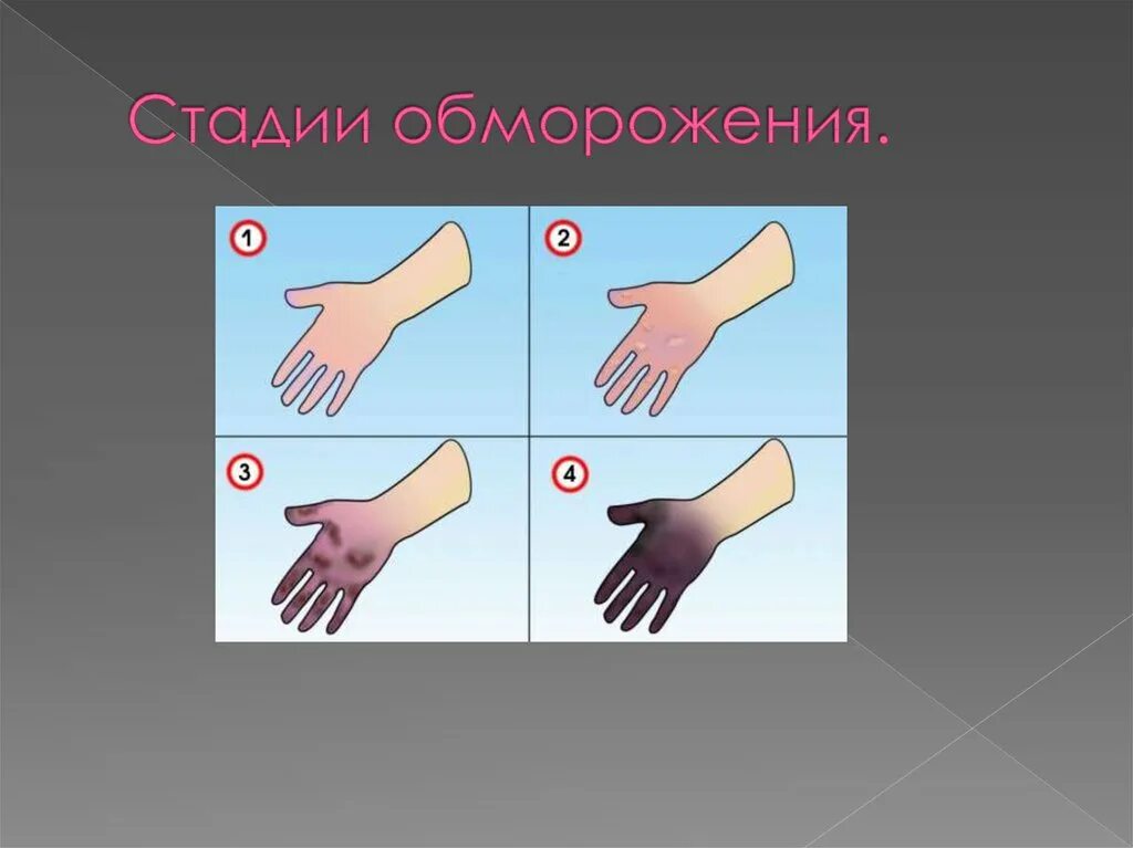 Холодное обморожение