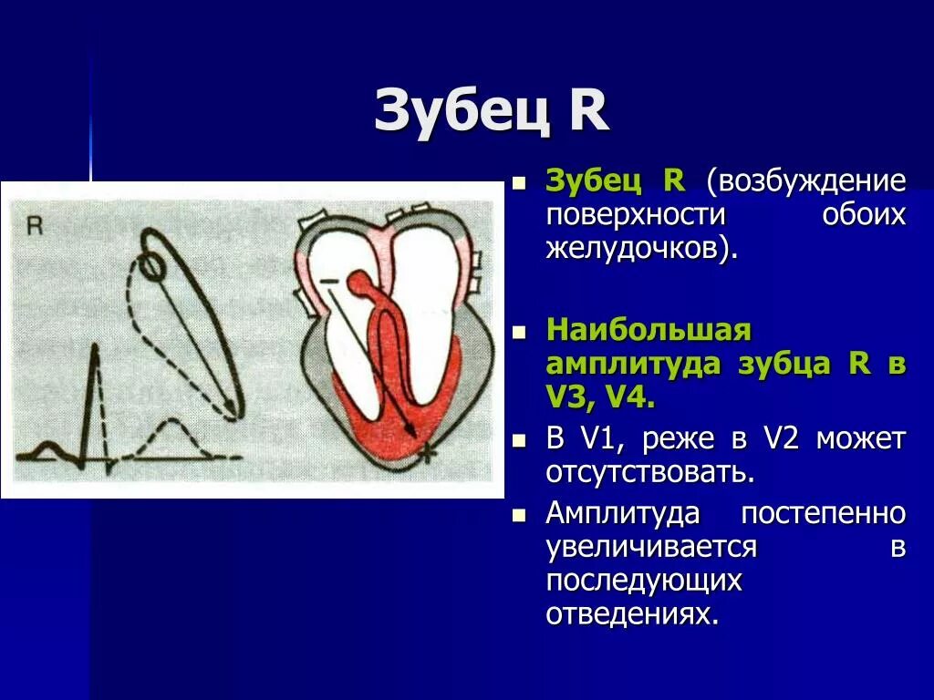 Расщепление зубца. Амплитуда зубца r. зубец r на экг. высокая амплитуда зубца r. амплитуда зубца r на экг.