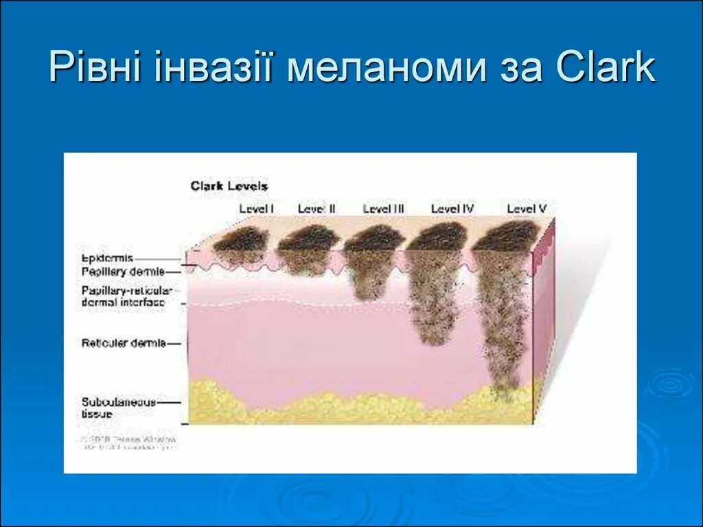 Инвазия по Кларку и Бреслоу. Классификация меланомы по Бреслоу. Стадии инвазии по Кларку. Уровни инвазии меланомы по Кларку.