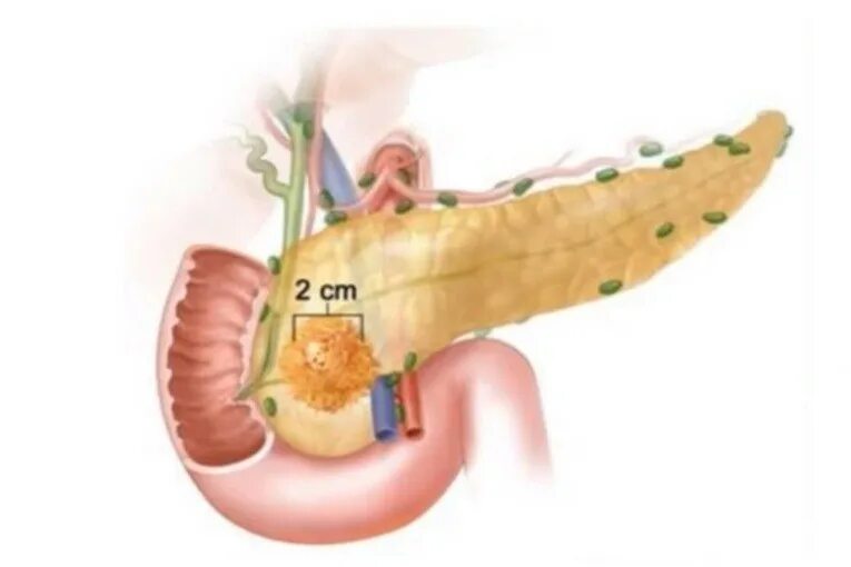 4 стадия поджелудочной железы сколько живут. Карциномы протоков поджелудочной железы. Доброкачественная опухоль поджелудочной. Доброкачественная опухоль поджелудочной железы. Опухоль 3мм поджелудочной железы.