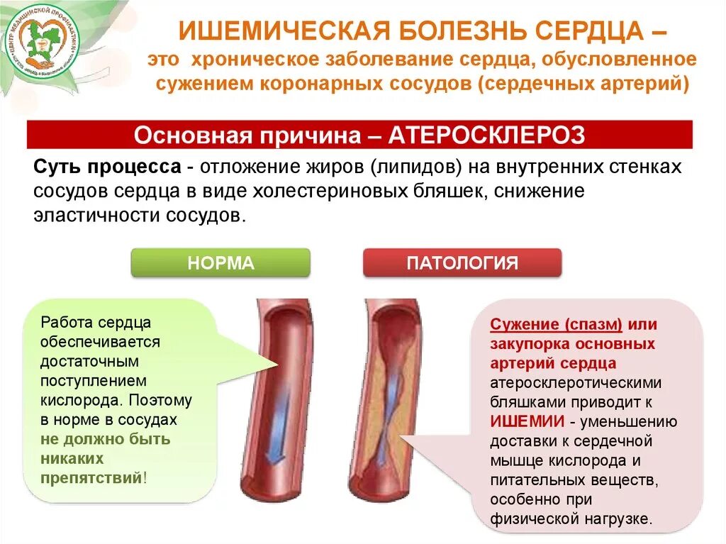 Ишемическая болезнь сердца лечение и профилактика. Снижение эластичности сосудов. Сужение сосудов сердца лечение.