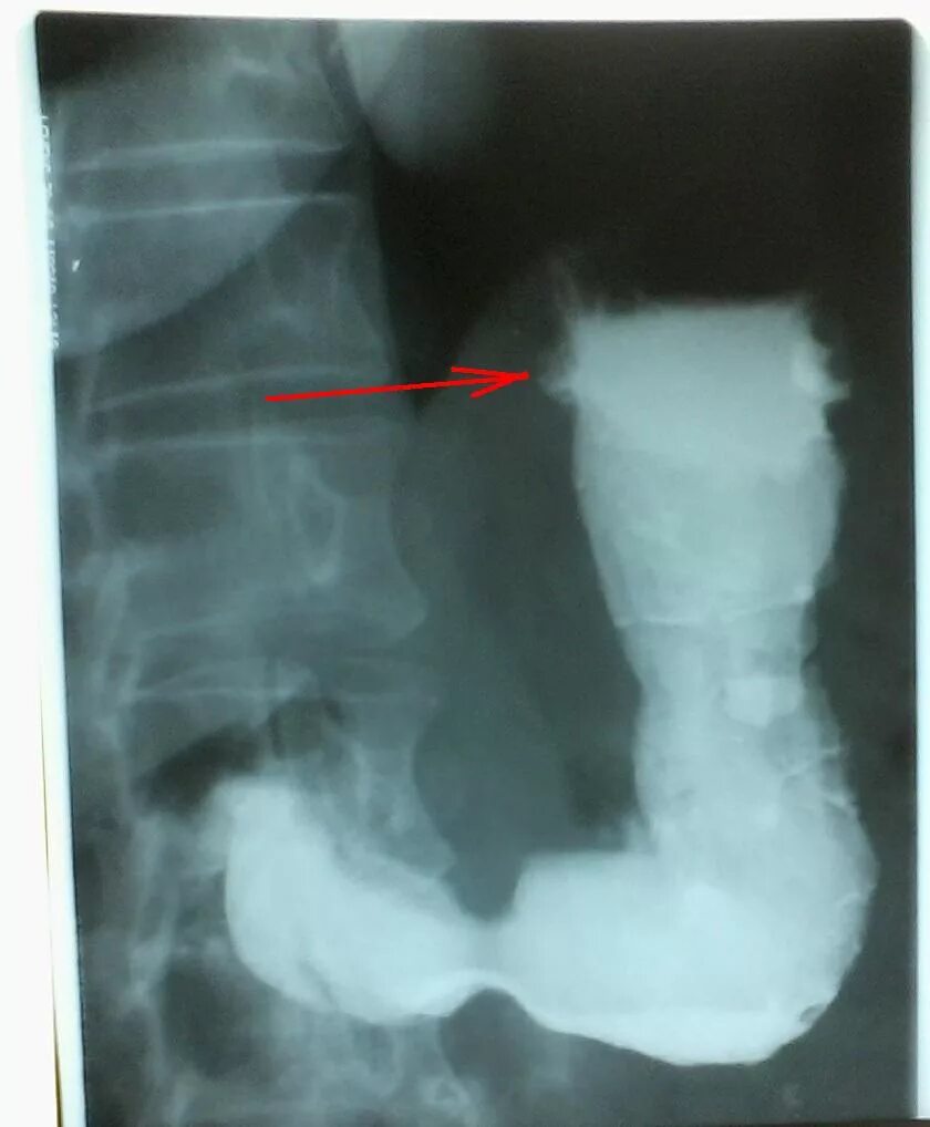 Рентгеноскопия желудка с барием. Рентгеноскопия желудка с барием норма. Рентгенограмма желудка в норме. Атония желудка рентген. Скопия пищевода желудка