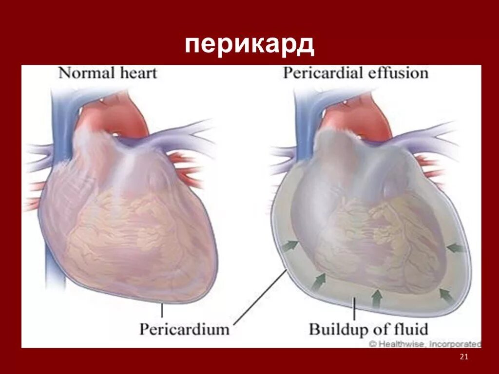 Скопление воздуха в перикарде латынь