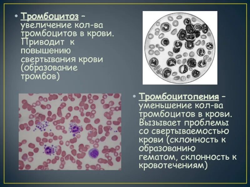 Повышенное количество крупных тромбоцитов. Изменения количества тромбоцитов. Повышение тромбоцитов. Картина крови при тромбоцитопении.