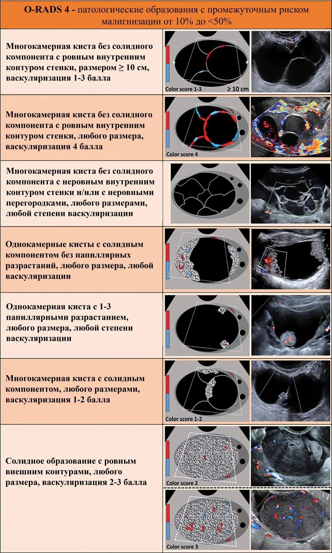 O rads 3. O rads классификация яичников мрт. Orads классификация образований яичников. O-rads УЗИ. Классификация o-rads для УЗИ.