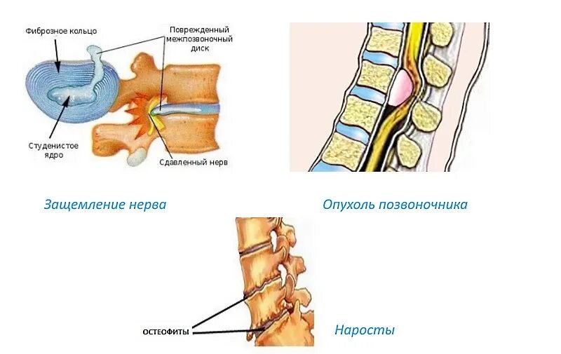 Защемление в пояснице лечение. Защемление позвоночника. Радикулопатия пояснично-крестцового отдела позвоночника. Защемление диска позвоночника. Защемление нерва в позвоночнике.