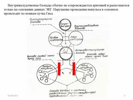 Желудочковая блокада