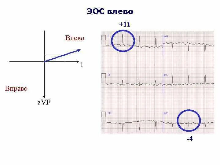 Смещение эос влево. Отклонение оси влево на экг. ось вправо на экг. отклонение электрической оси вправо на экг. эос влево на экг.
